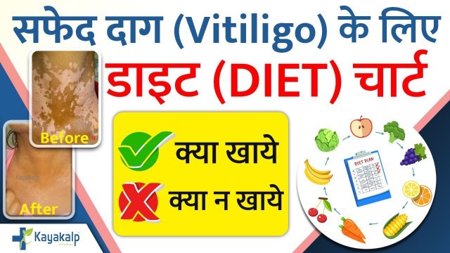 'Vitiligo Diet Plan/Chart in Hindi | सफेद दाग के लिए डाइट चार्ट | Vitiligo What Foods to Eat & Avoid'