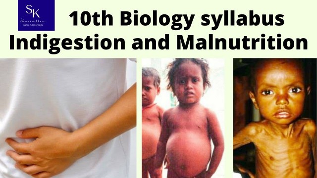 'Nutrition- Food supplying system (part- 6) # Indigestion and Malnutrition # 10th Biology syllabus.'