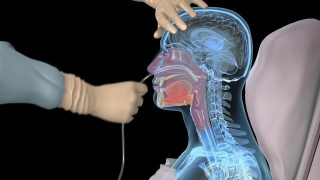 'NG Intubation (Inserting a nasogastric tube) - 3D medical animation'