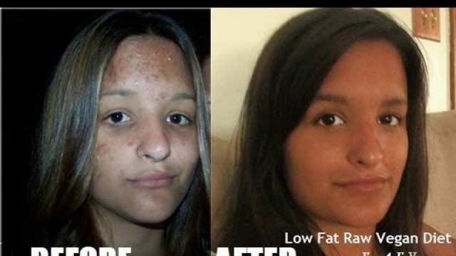 'Raw Food Cured my Chronic Acne, Depression, UTI\'s, IBS and Being Underweight.'